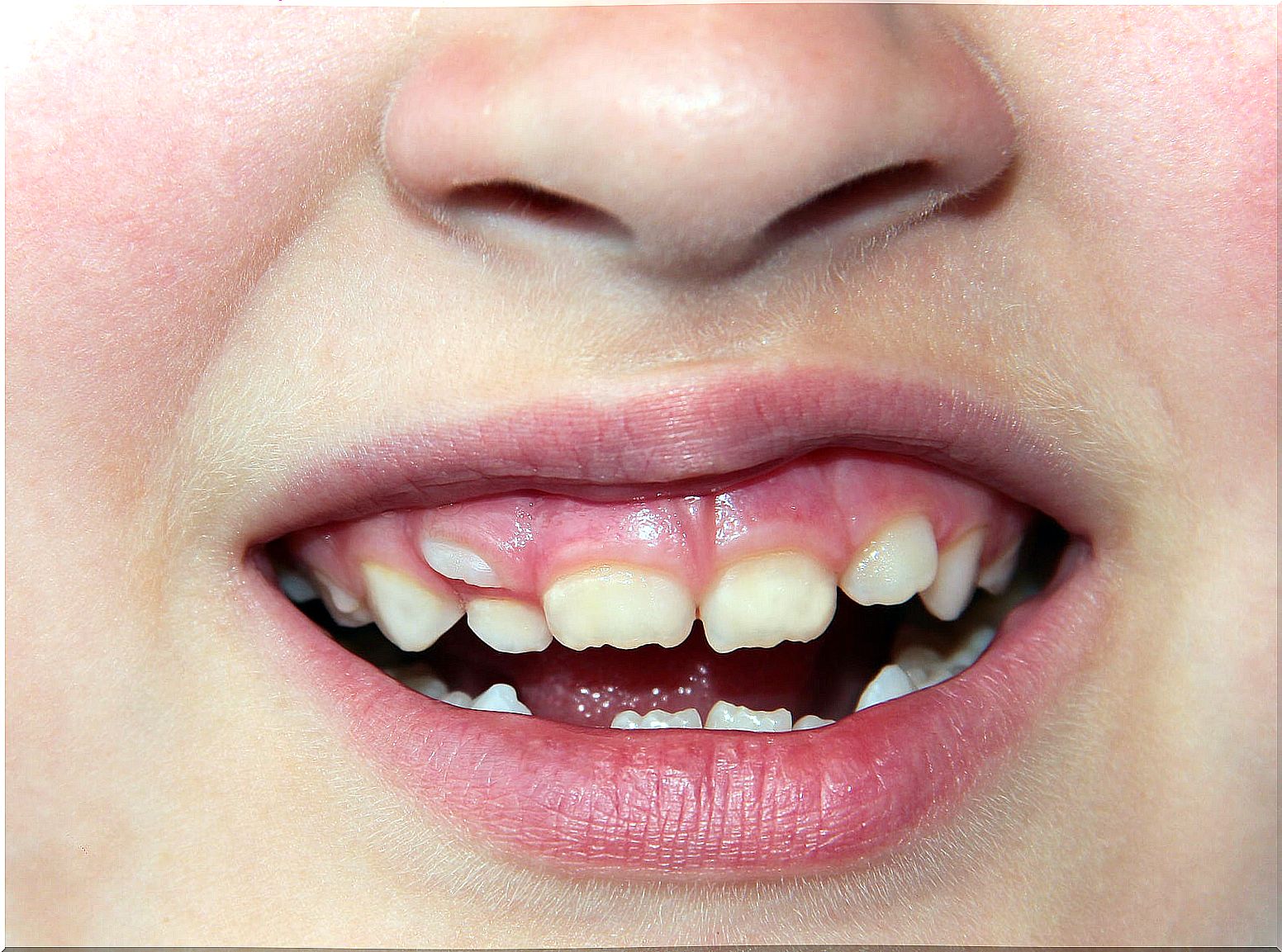 Dental crowding in children: how is it corrected?