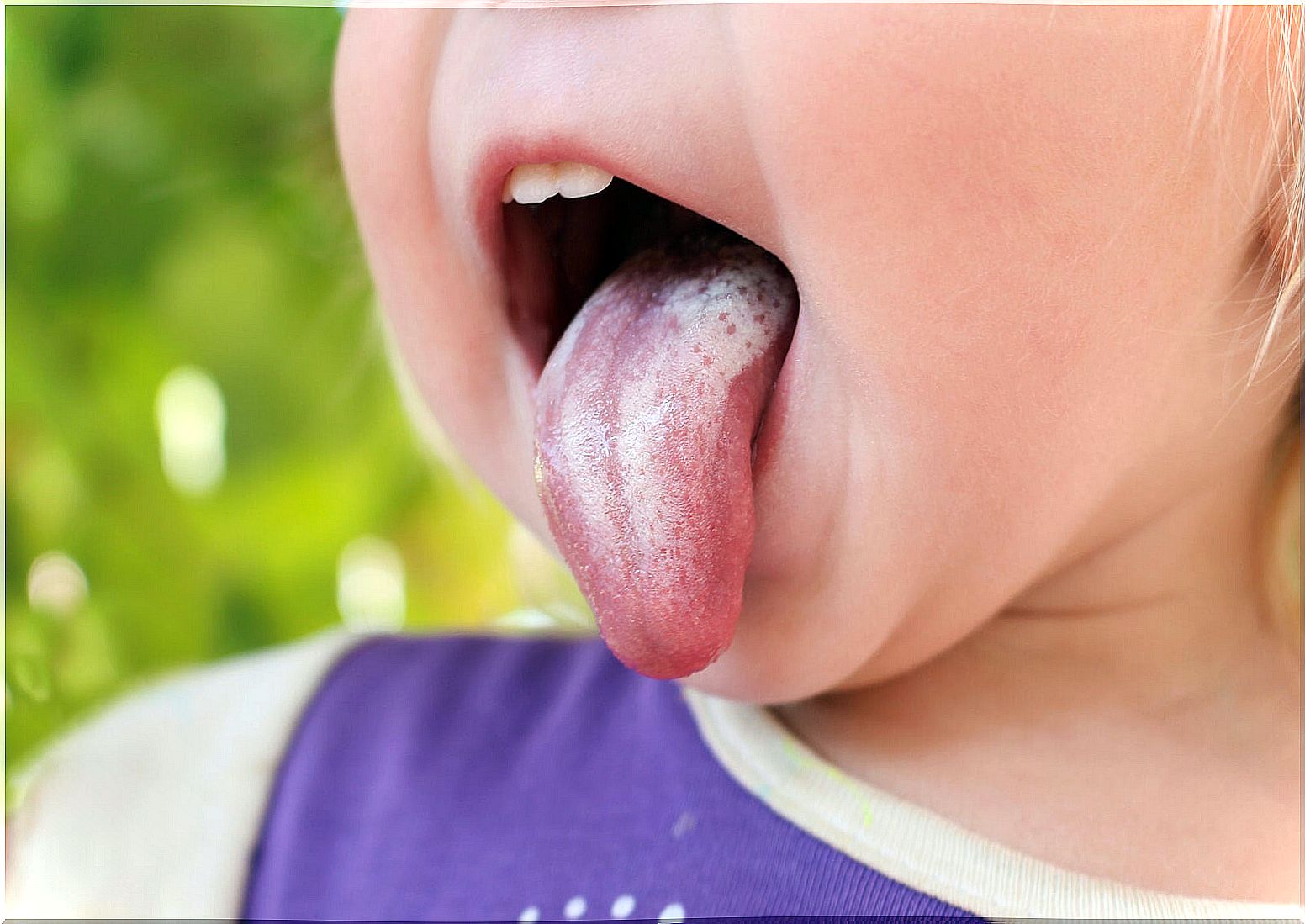 Oral candidiasis in children: symptoms, causes and treatment