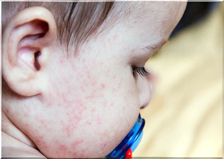 Skin irritations in babies, what to do?