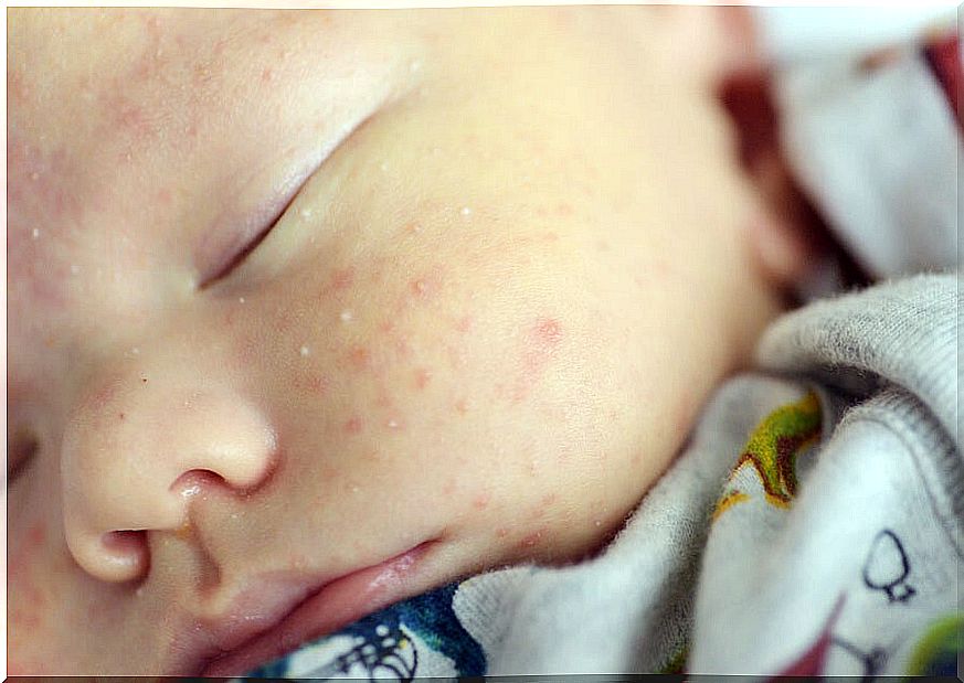 Toxic erythema in the newborn