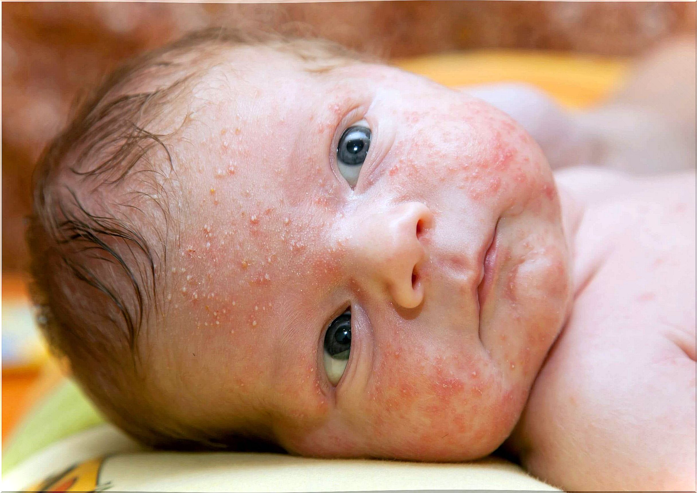 Neonatal acne treatment